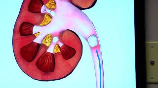 Ureteroscopy Procedure for Kidney Stones