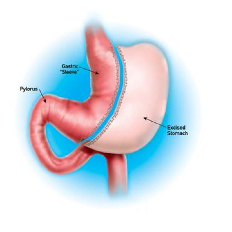 gastric sleeve diagram