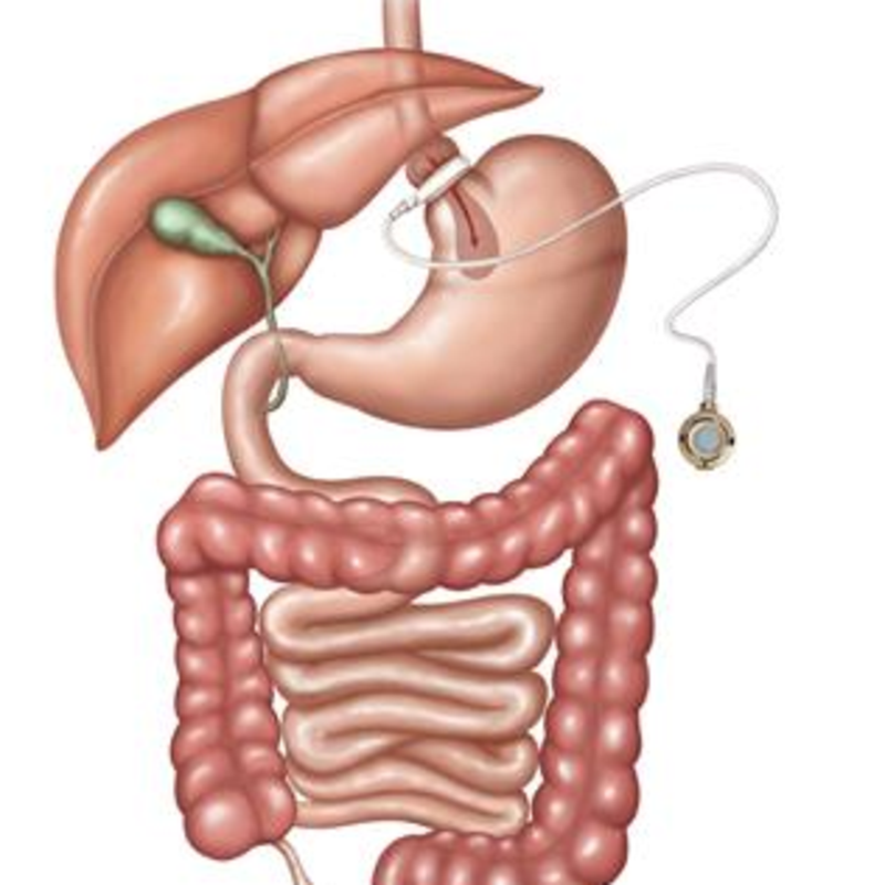 adjustable gastric diagram