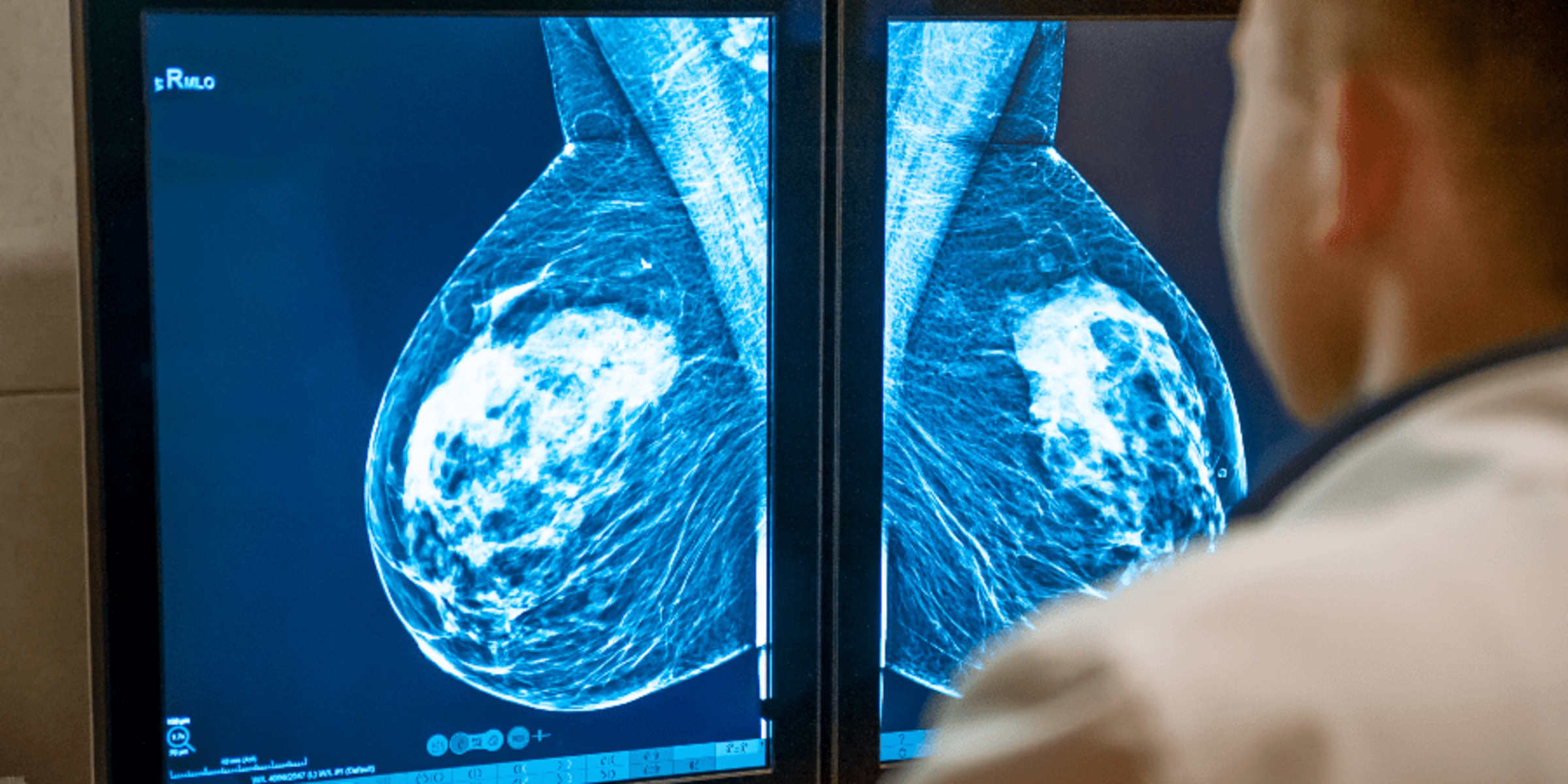 breast cancer screening doctor looking at mammogram