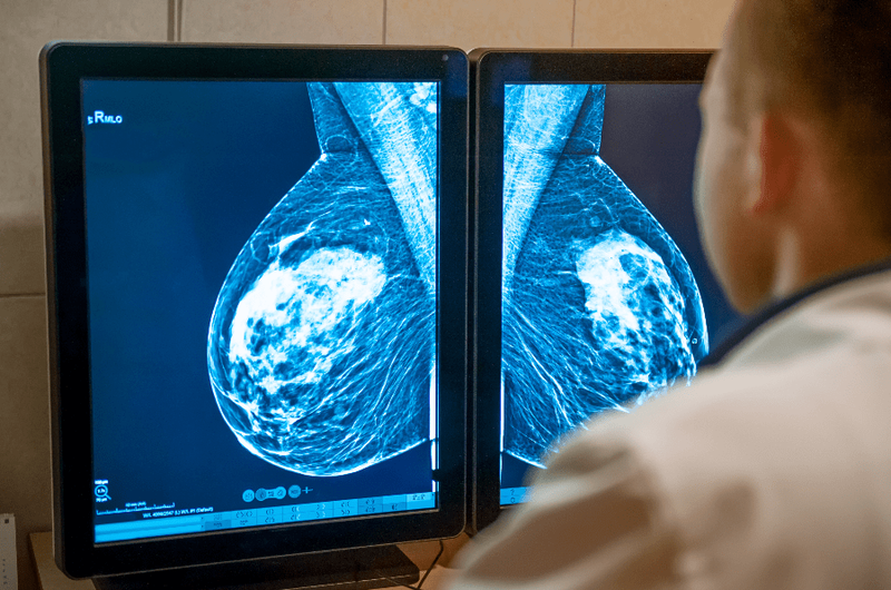 breast cancer screening doctor looking at mammogram