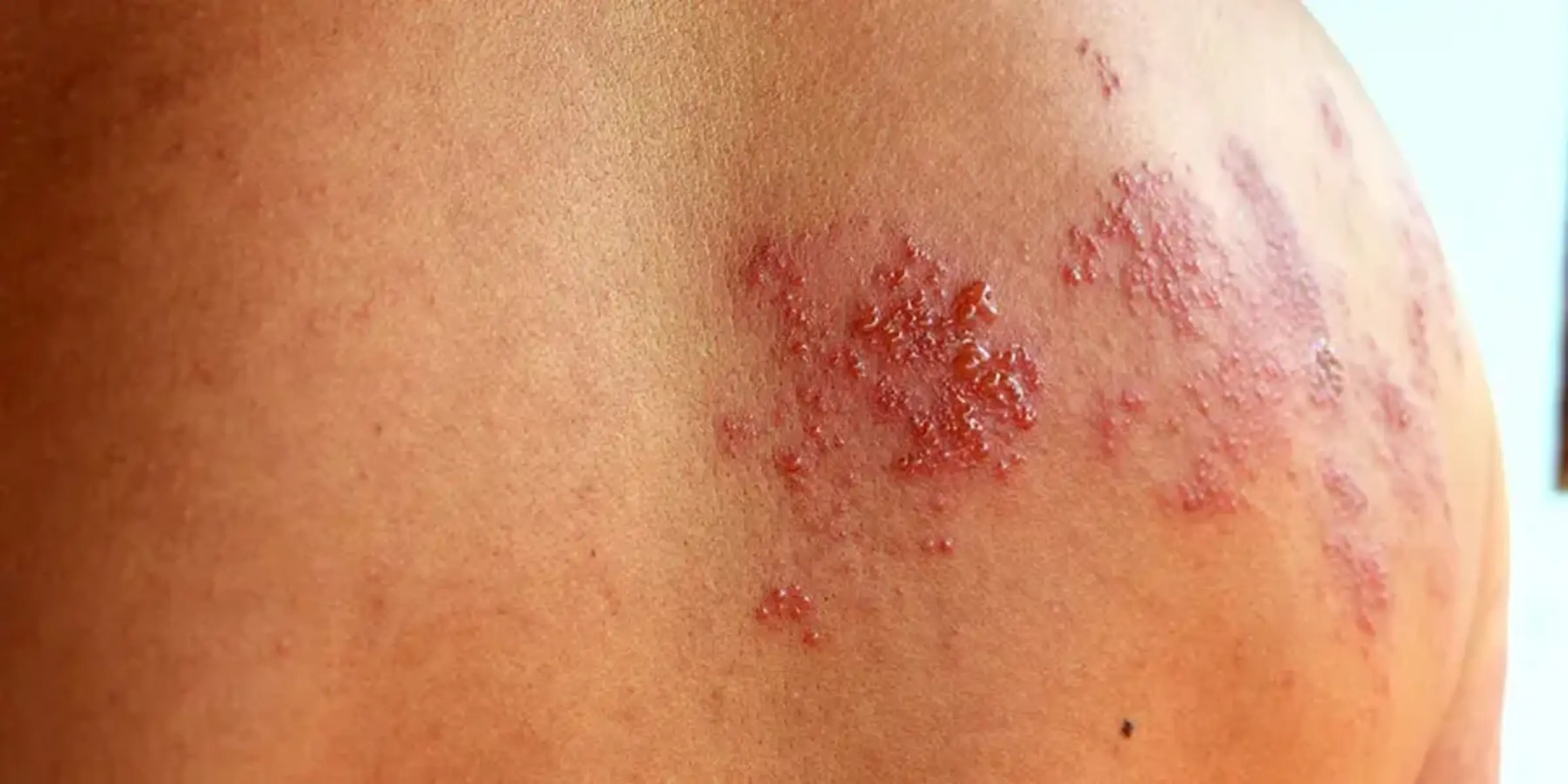 shingles on man's back