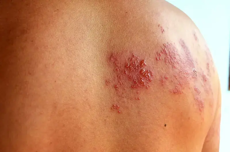 shingles on man's back