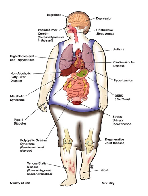 Bariatric-diagram Bariatric-diagram
