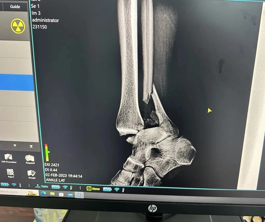 Renee Lyons’ ankle xray