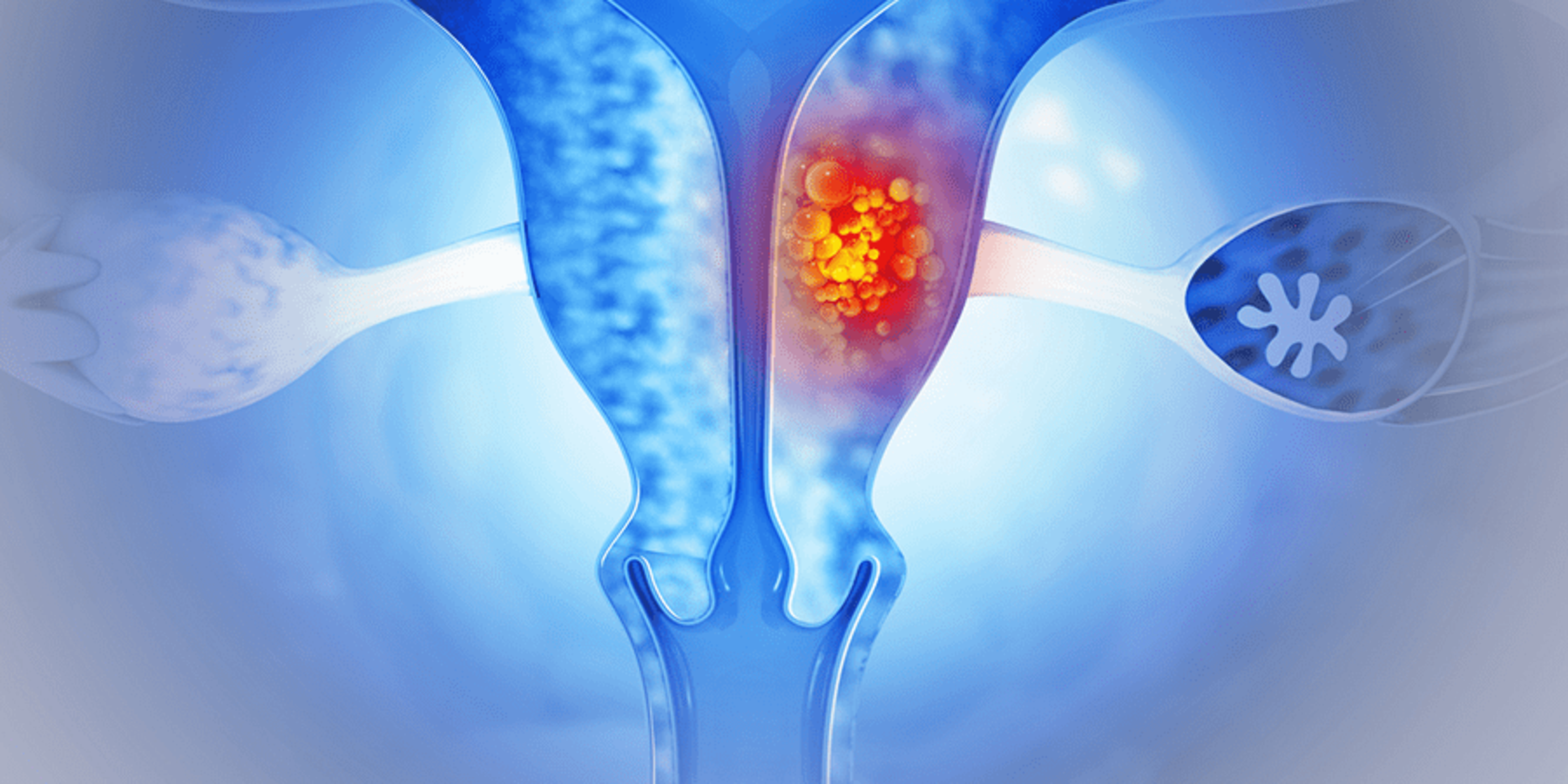 Brachytherapy afterloaders ovaries