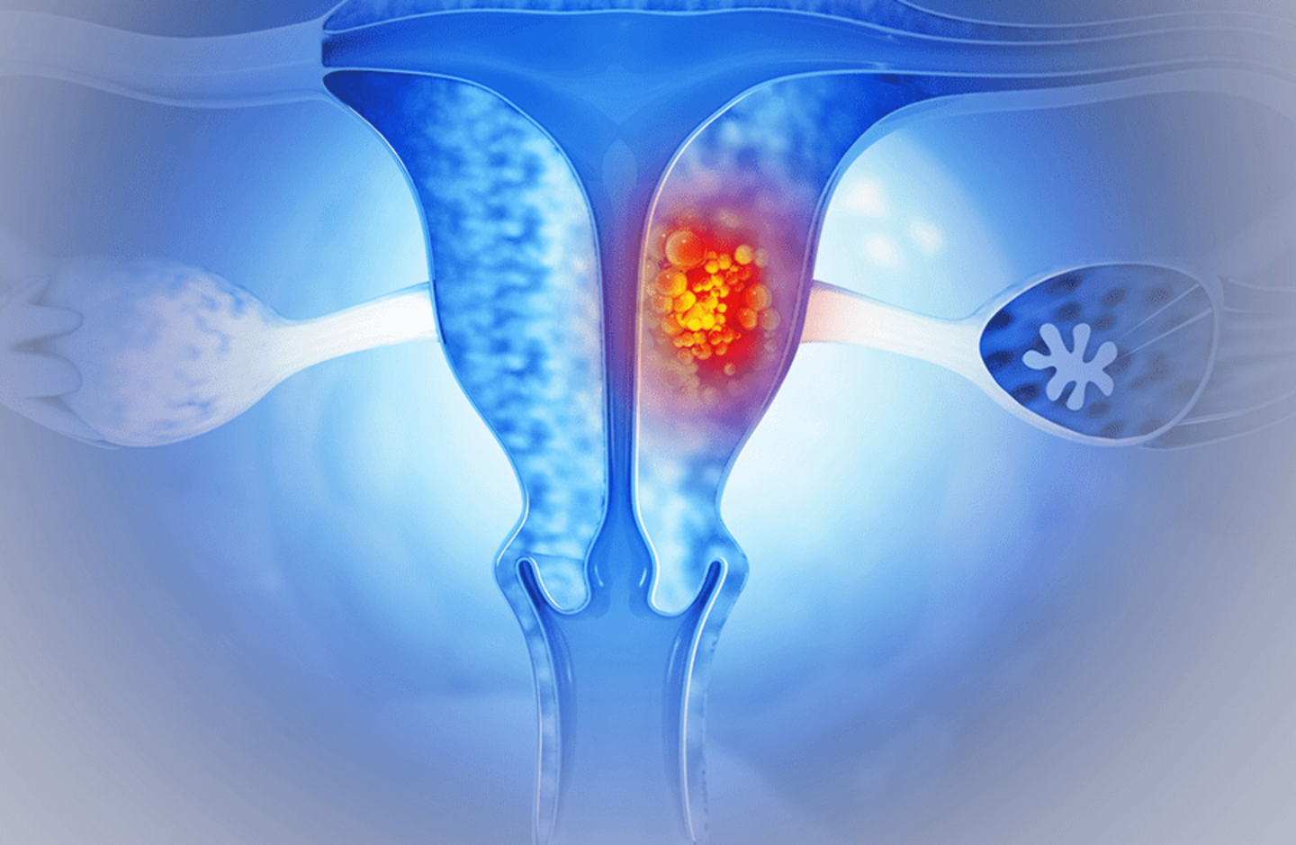 Brachytherapy afterloaders ovaries