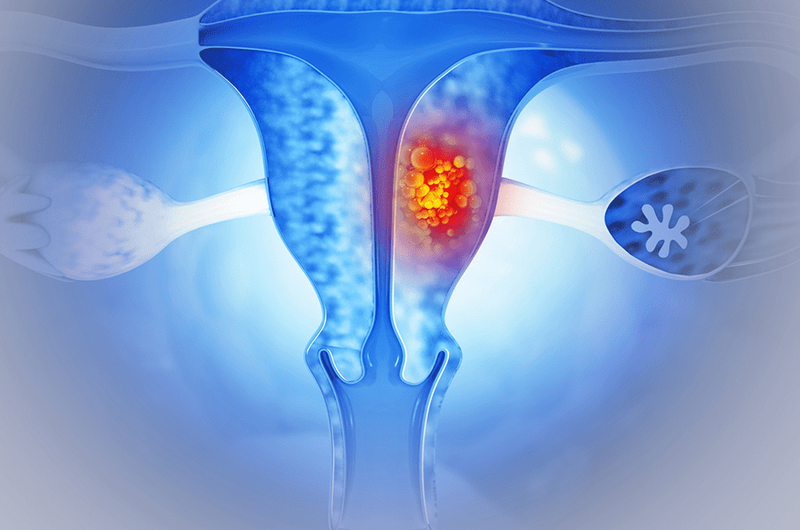 Brachytherapy afterloaders ovaries