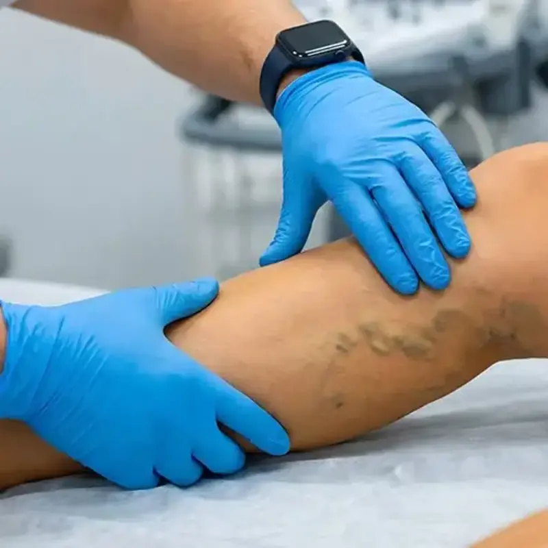 Exam on varicose veins