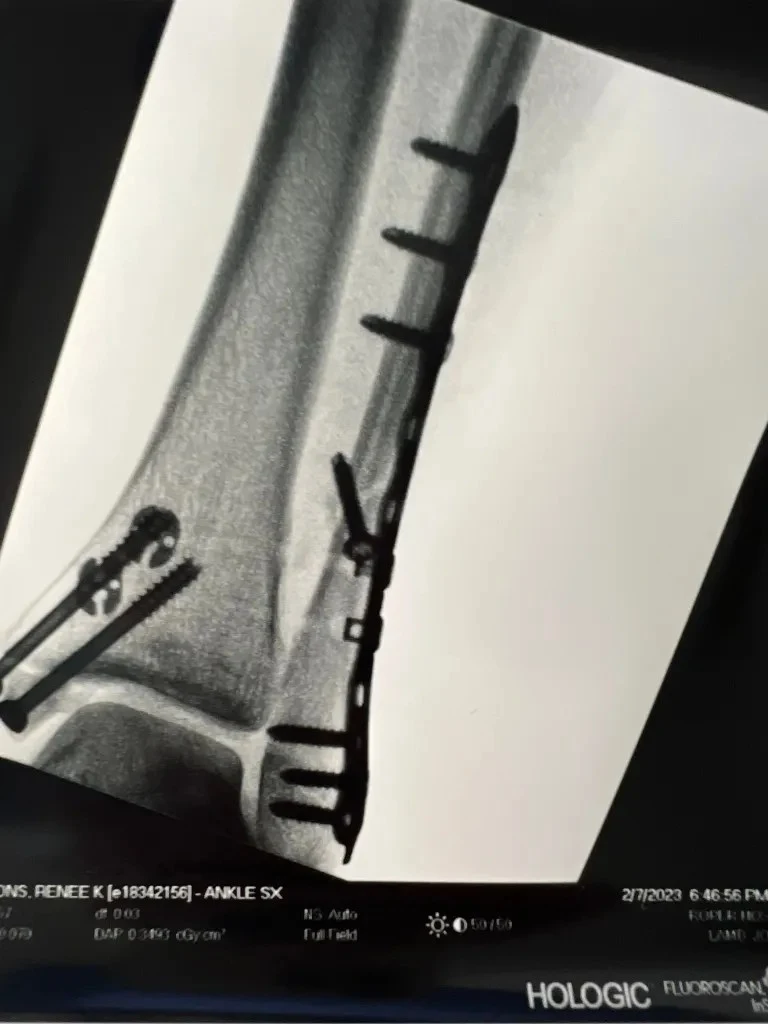 xray of Renee’s ankle