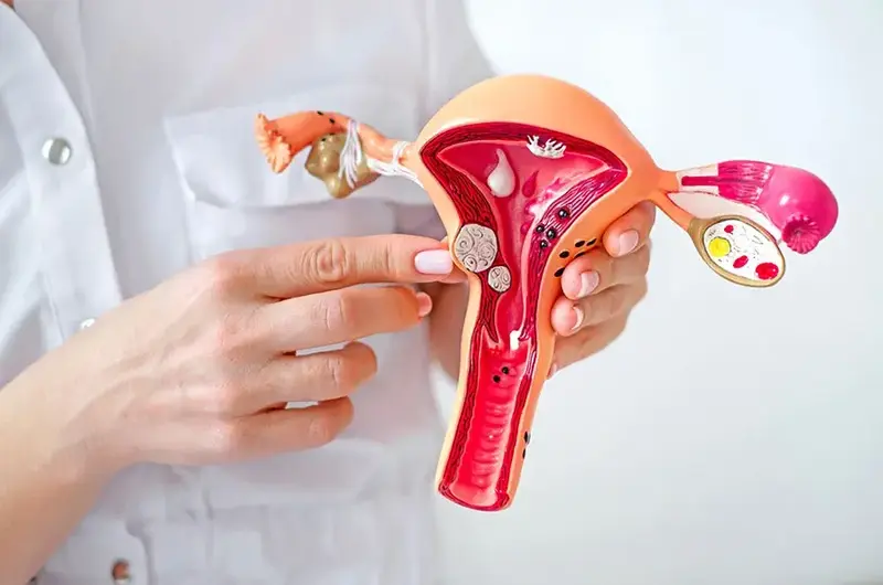 fibroid tumors on a 3D model