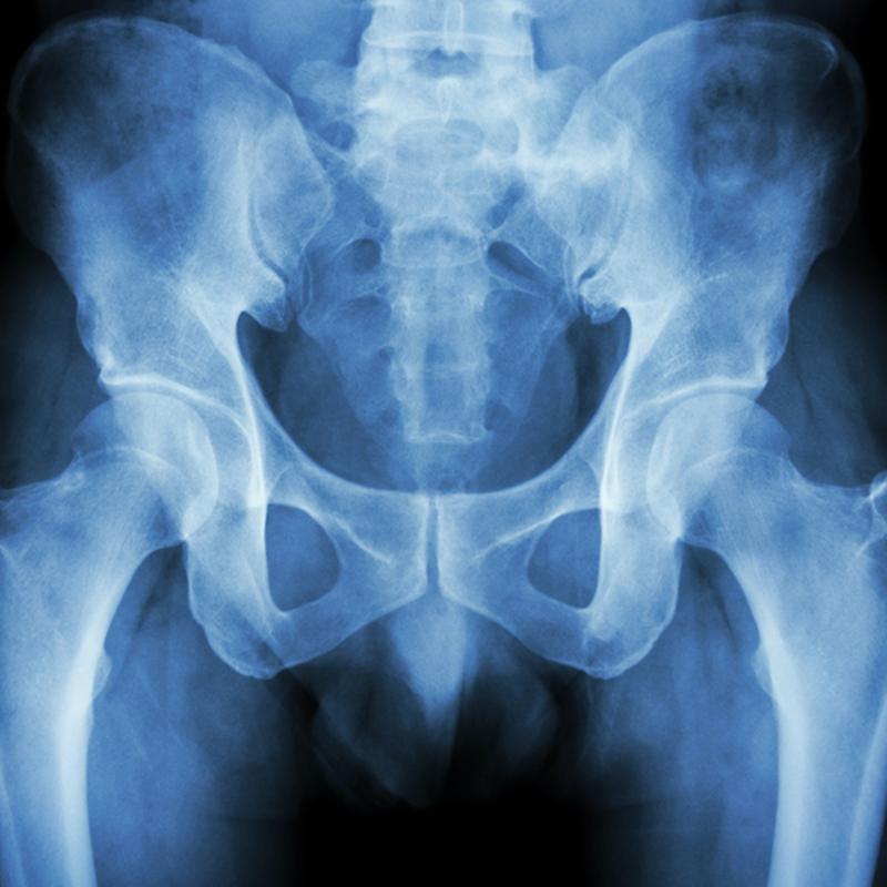 pelvic xray