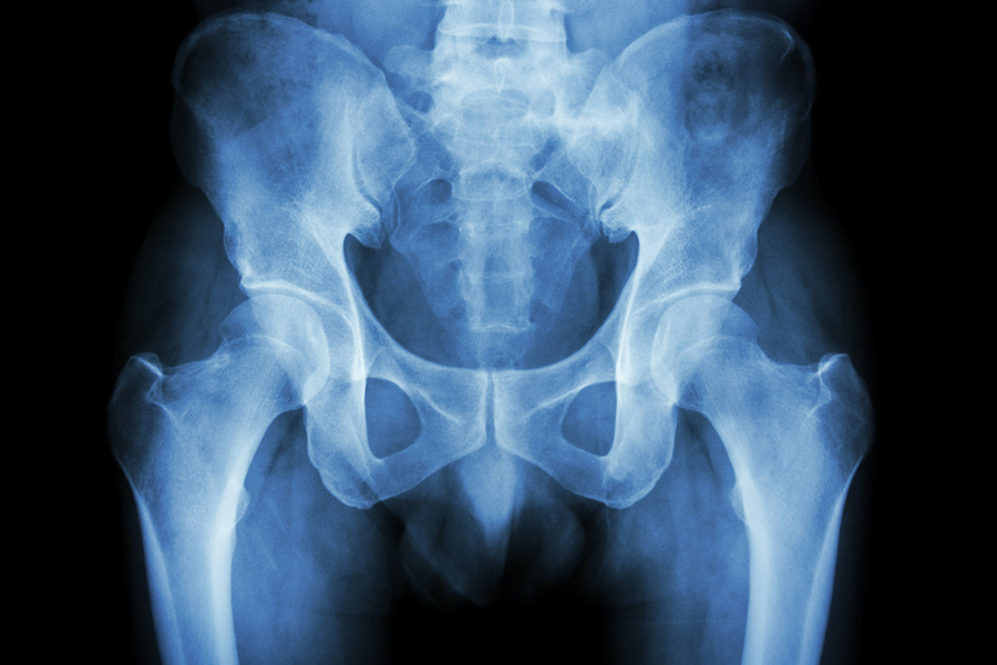 complex-sacrectomy-neurosurgery-xray