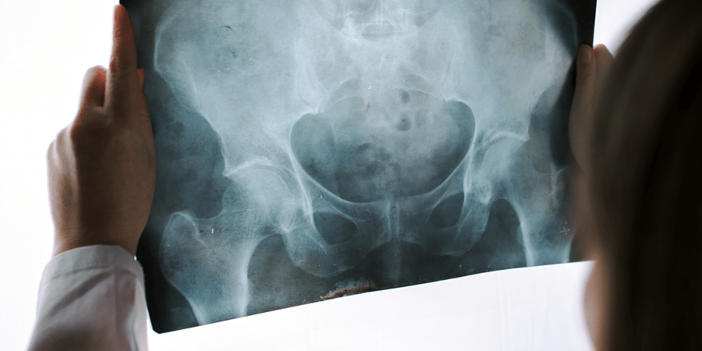 complex sacrectomy and doctor viewing xray