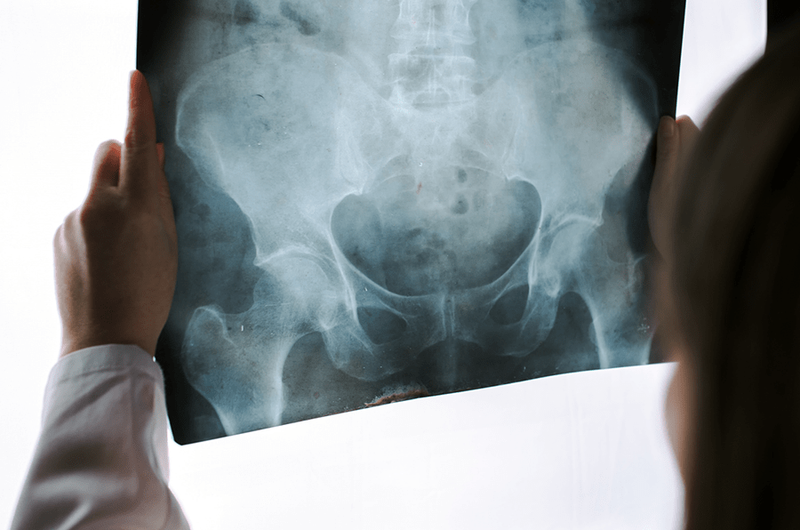 complex sacrectomy and doctor viewing xray