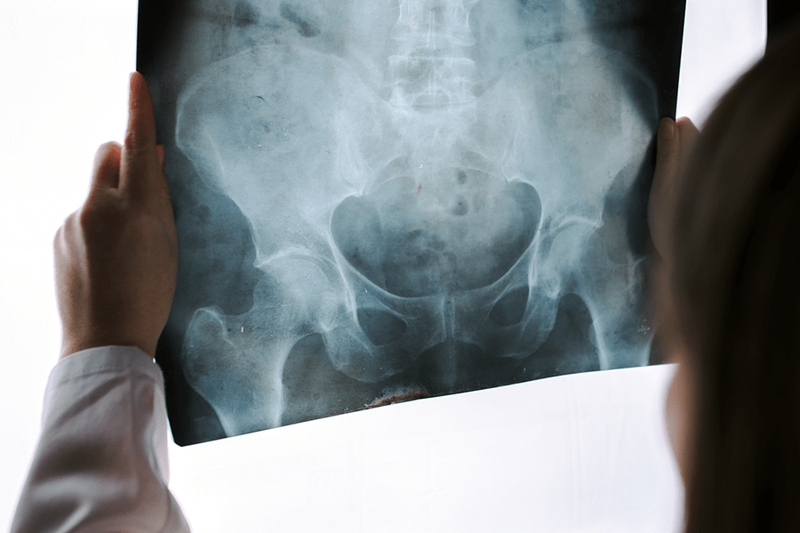 complex sacrectomy and doctor viewing xray