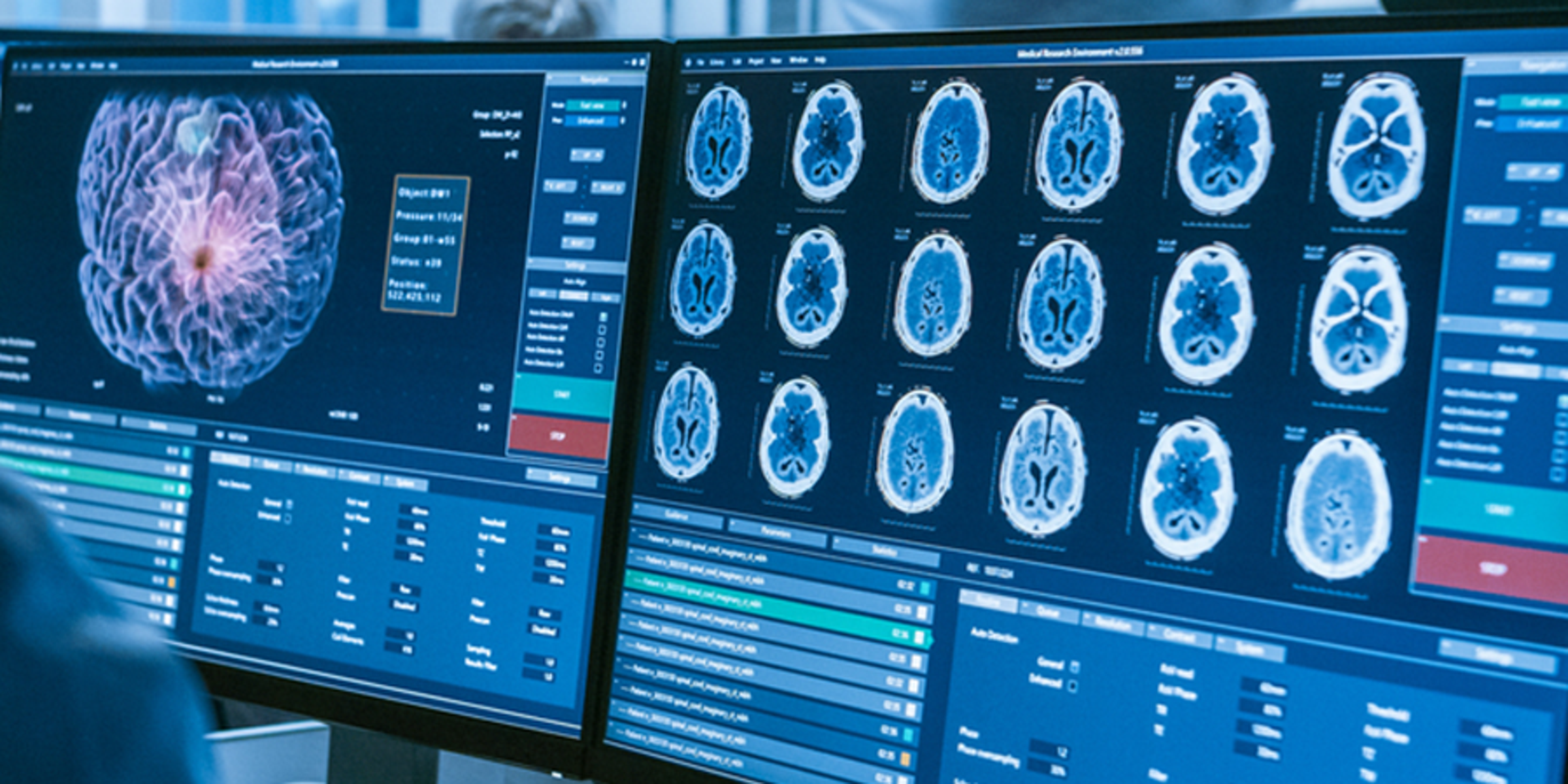 brain tumor image scan