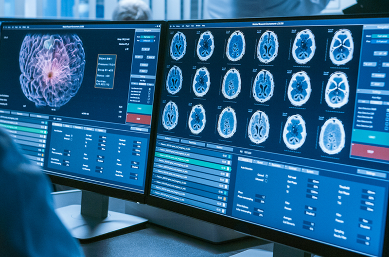 brain tumor image scan