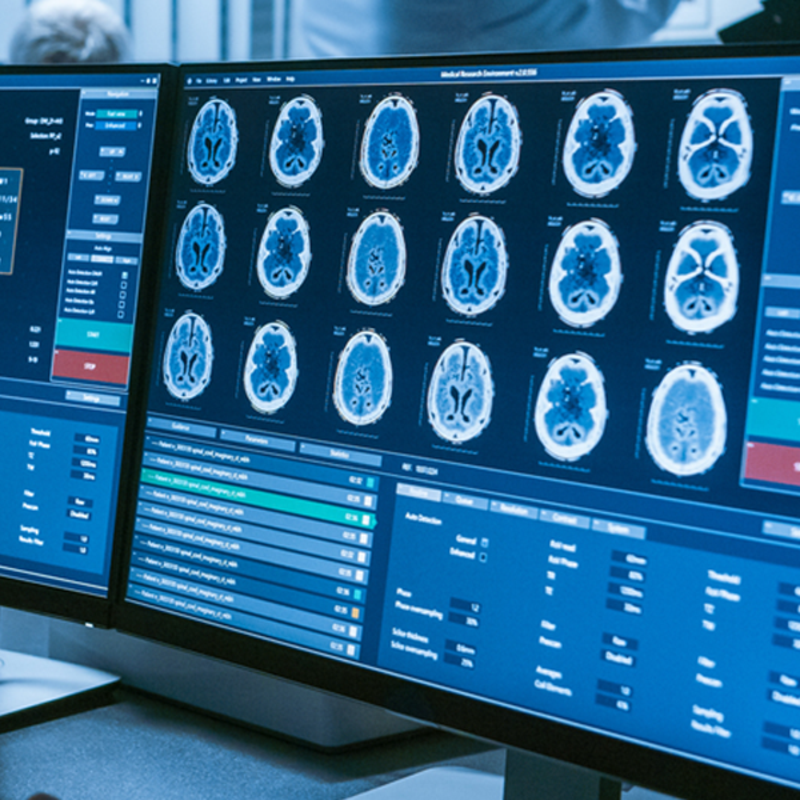 brain tumor image scan