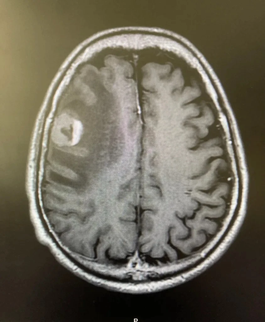 Imaging that shows Czarniecki’s brain tumor prior to surgery