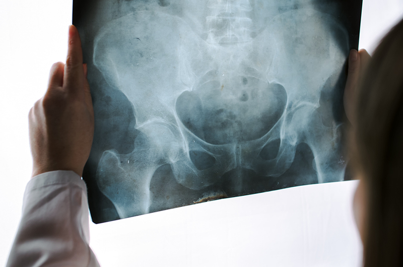 pelvis xray