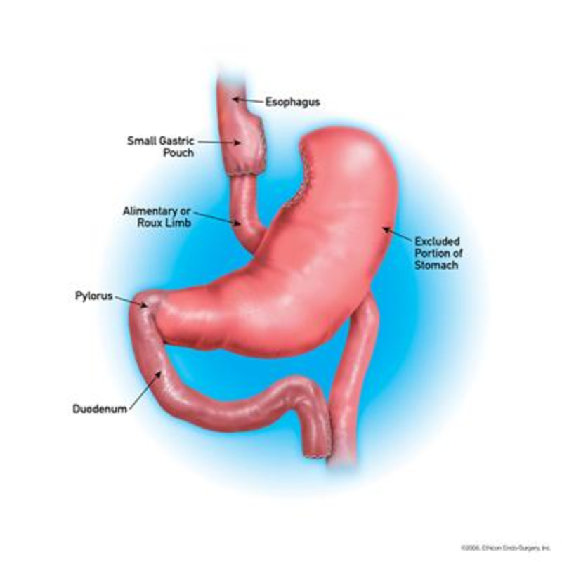 gastric bypass diagram