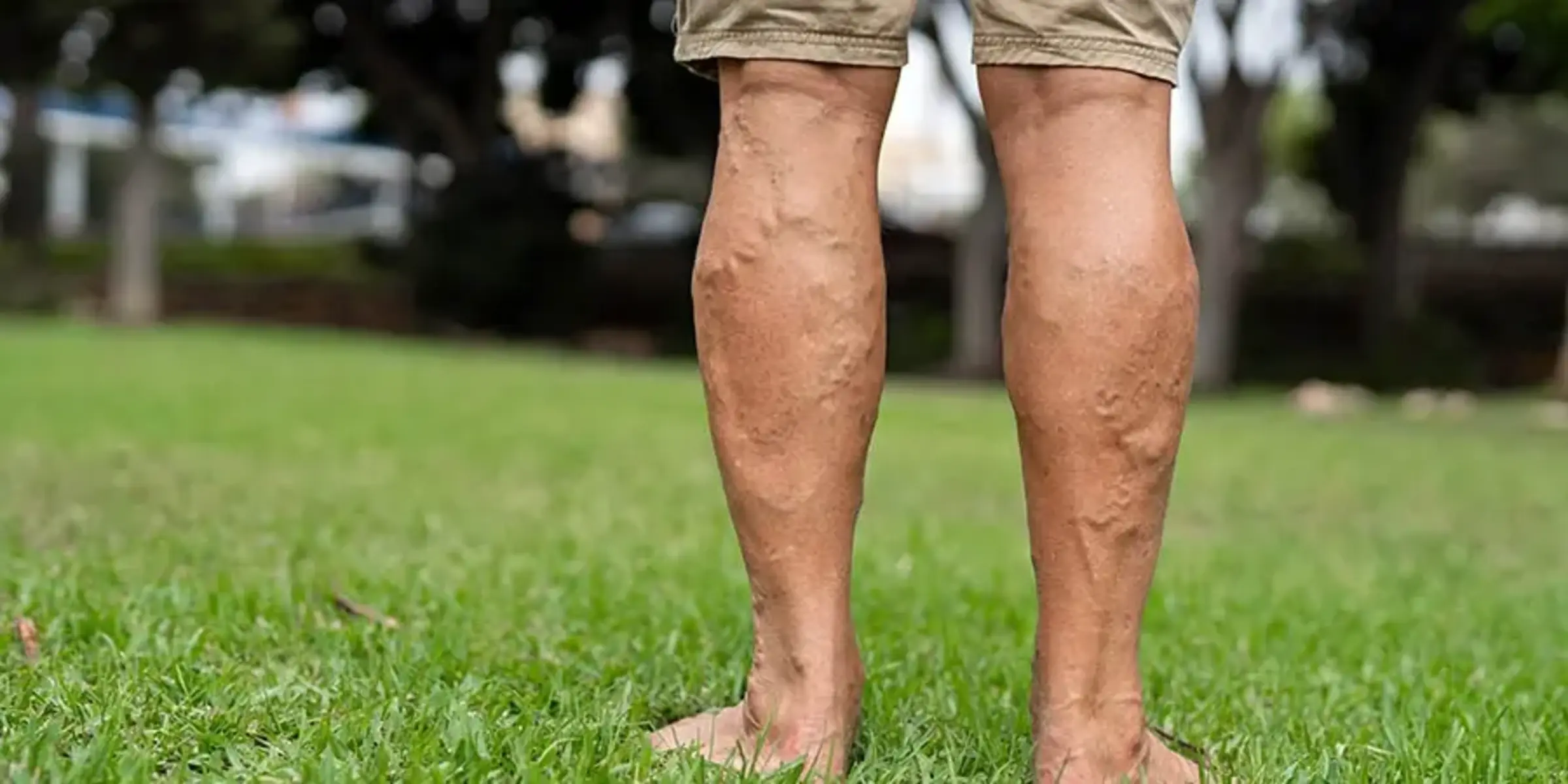 elderly man legs deep vein thrombosis