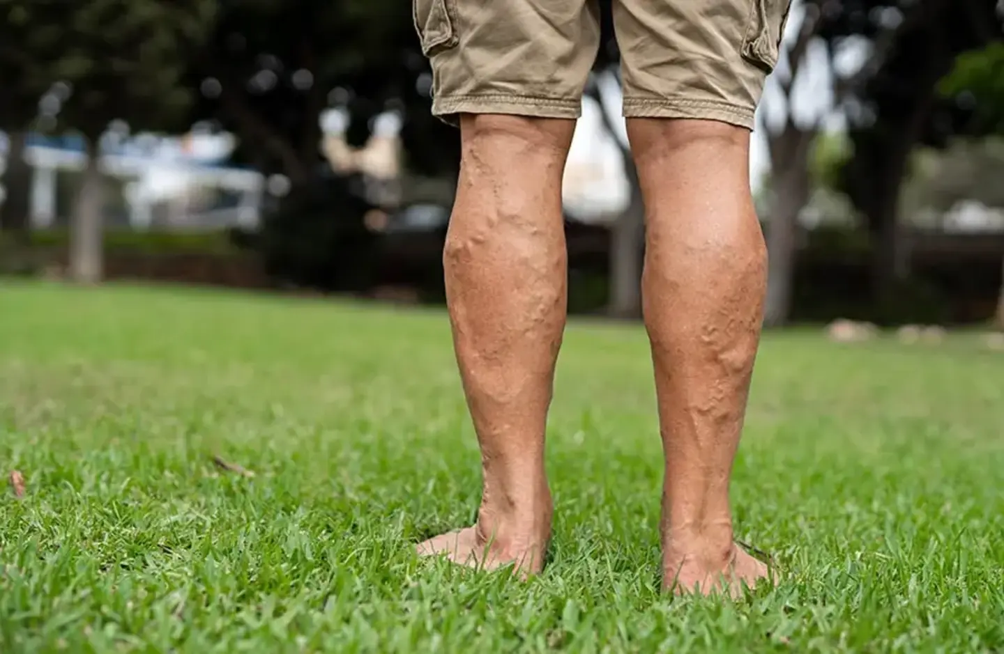 elderly man legs deep vein thrombosis