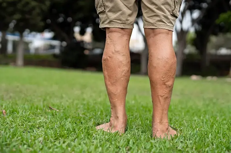 elderly man legs deep vein thrombosis