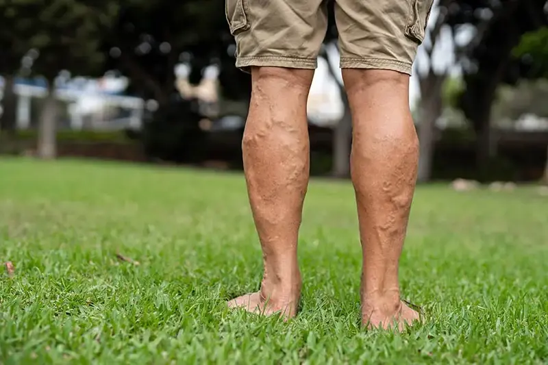 elderly man legs deep vein thrombosis