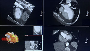 ct scan usinf APEX CT scanner;
